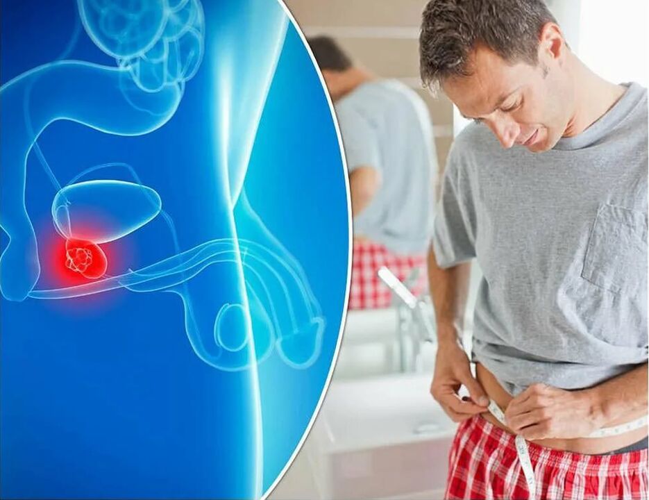 síntomas y causas de la prostatitis