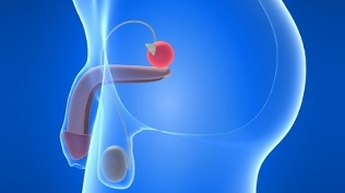 masaje de próstata para la prevención de la prostatitis
