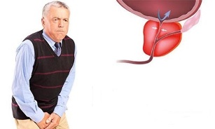síntomas de prostatitis en hombres