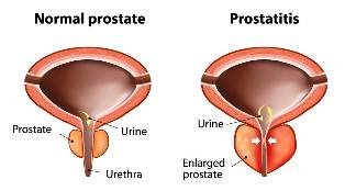 aguda, prostatitis tratamiento