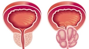 Razones para el desarrollo de prostatitis y adenoma de próstata. 