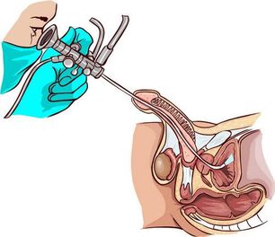 Procedimiento de ureteroscopia